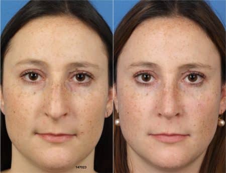 Rhinoplasty with Dr. Miller