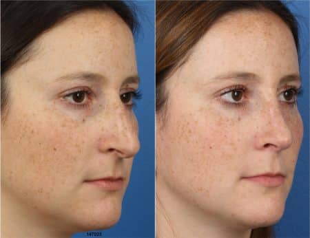 Rhinoplasty with Dr. Miller