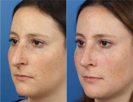 Rhinoplasty with Dr. Miller