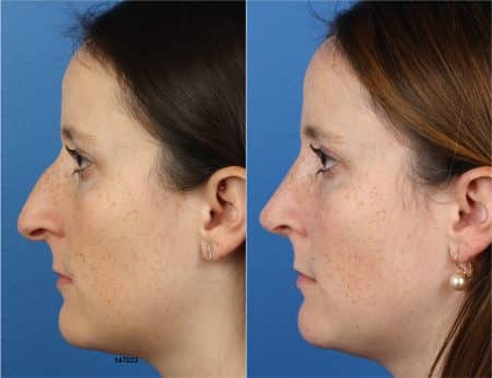 Rhinoplasty with Dr. Miller