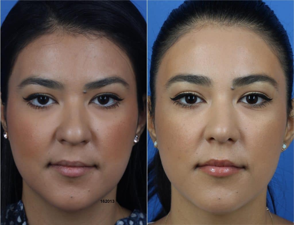 How to Make Your Face Less Flat? 6 Surgical and Non-surgical Options -  Philip Miller MD