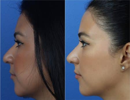 Rhinoplasty and Buccal Fat Removal with Dr. Miller