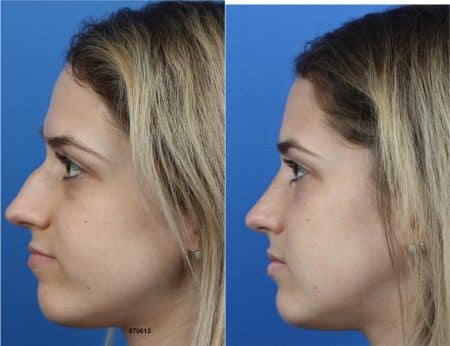 Rhinoplasty with Dr. Miller