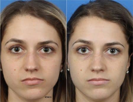 Rhinoplasty with Dr. Miller