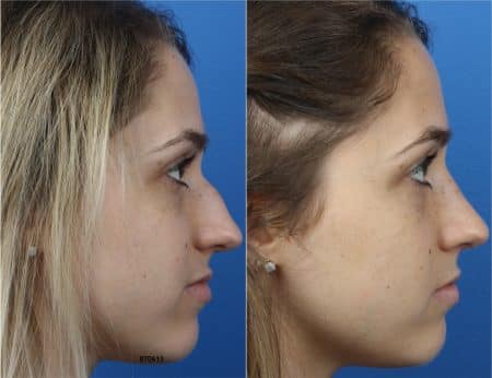 Rhinoplasty with Dr. Miller