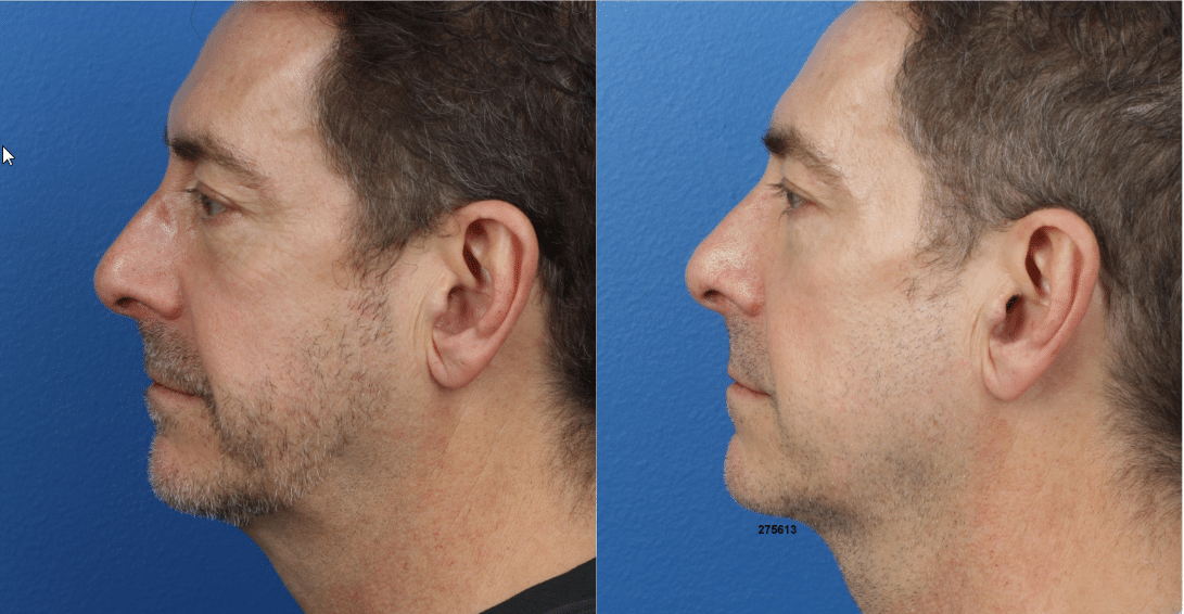 G.I. jaw and NeckTite to augment the chin and address skin laxity on a male patient. Chin is stronger with better definition between the jawline and neck.