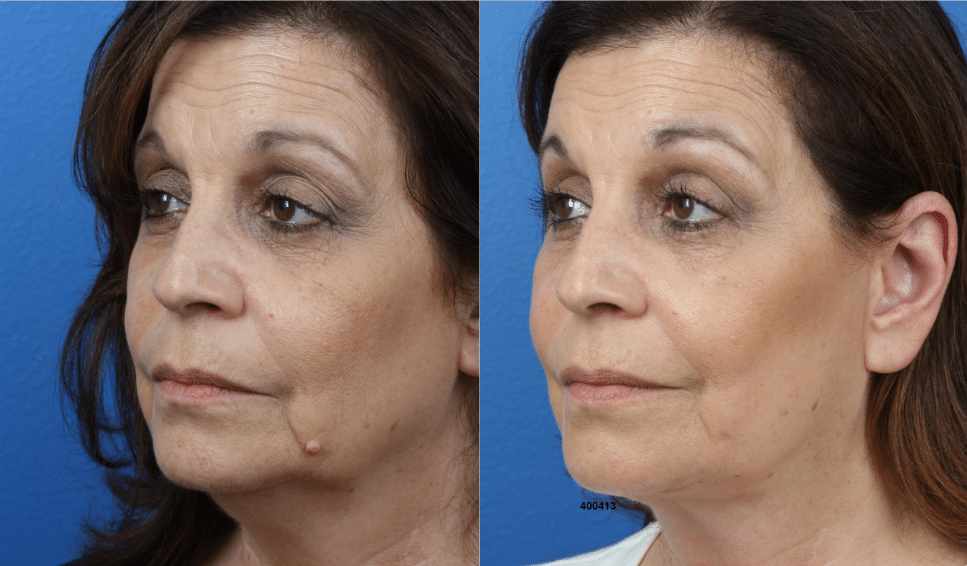 NatraEye, NatraLift and facial fat grafting treatment to reduce wrinkles and restore facial volume on a female patient. After treatment, patient's midface and jowls are lifted and skin looks visible smoother with fewer lines and wrinkles.