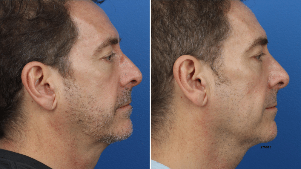 Chin augmentation using the G.I. Jaw technique (trademark of Dr. Philip Miller) and skin tightening using Necktite on a male patient. Increased fullness in the chin gives patient a more proportionate profile and better definition along the jawline.