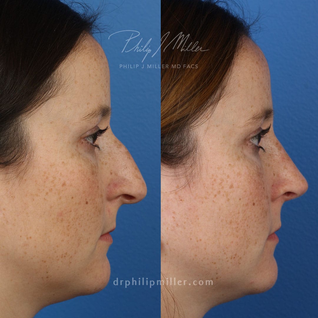 Rhinoplasty to refine the bridge and tip with Dr. Miller. After surgery, bridge is straighter and tip is slightly raised.