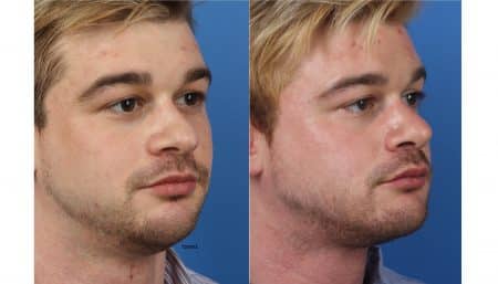 NatraNose, Buccal Fat Removal, NatraChin, Submental Liposuction, and Necktite with Dr. Miller