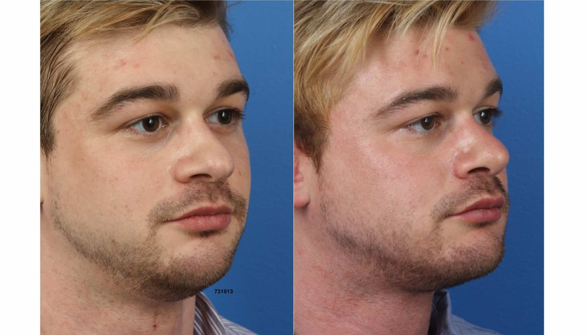 NatraNose, Buccal Fat Removal, NatraChin, Submental Liposuction, and Necktite with Dr. Miller