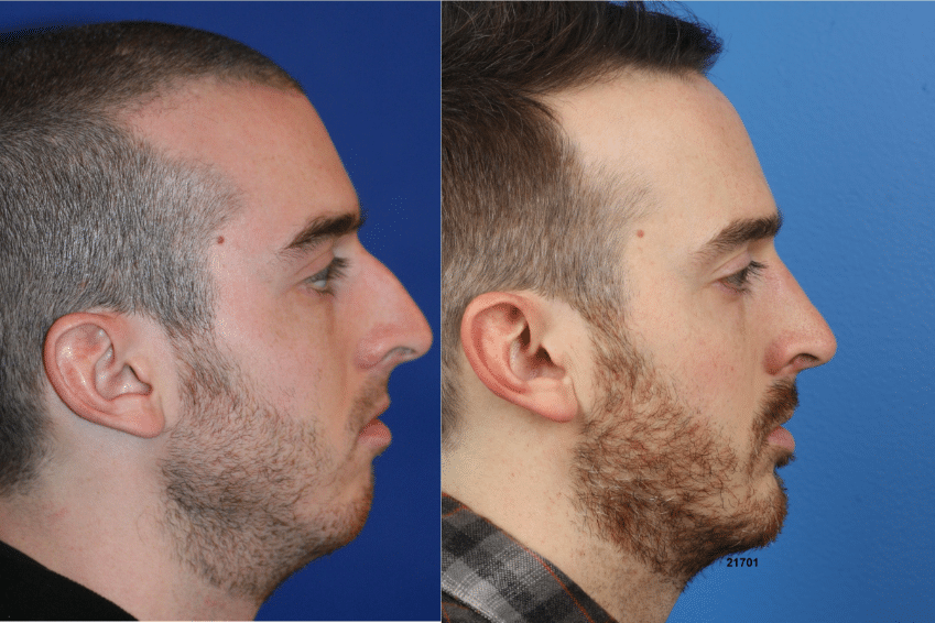 NatraNose rhinoplasty to refine the profile of a male patient. After sugery, nasal bridge is straighter and tip is refined to create a more aesthetically pleasing facial profile.