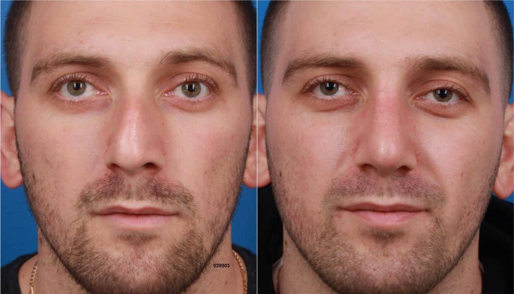 crooked nose correction in new york