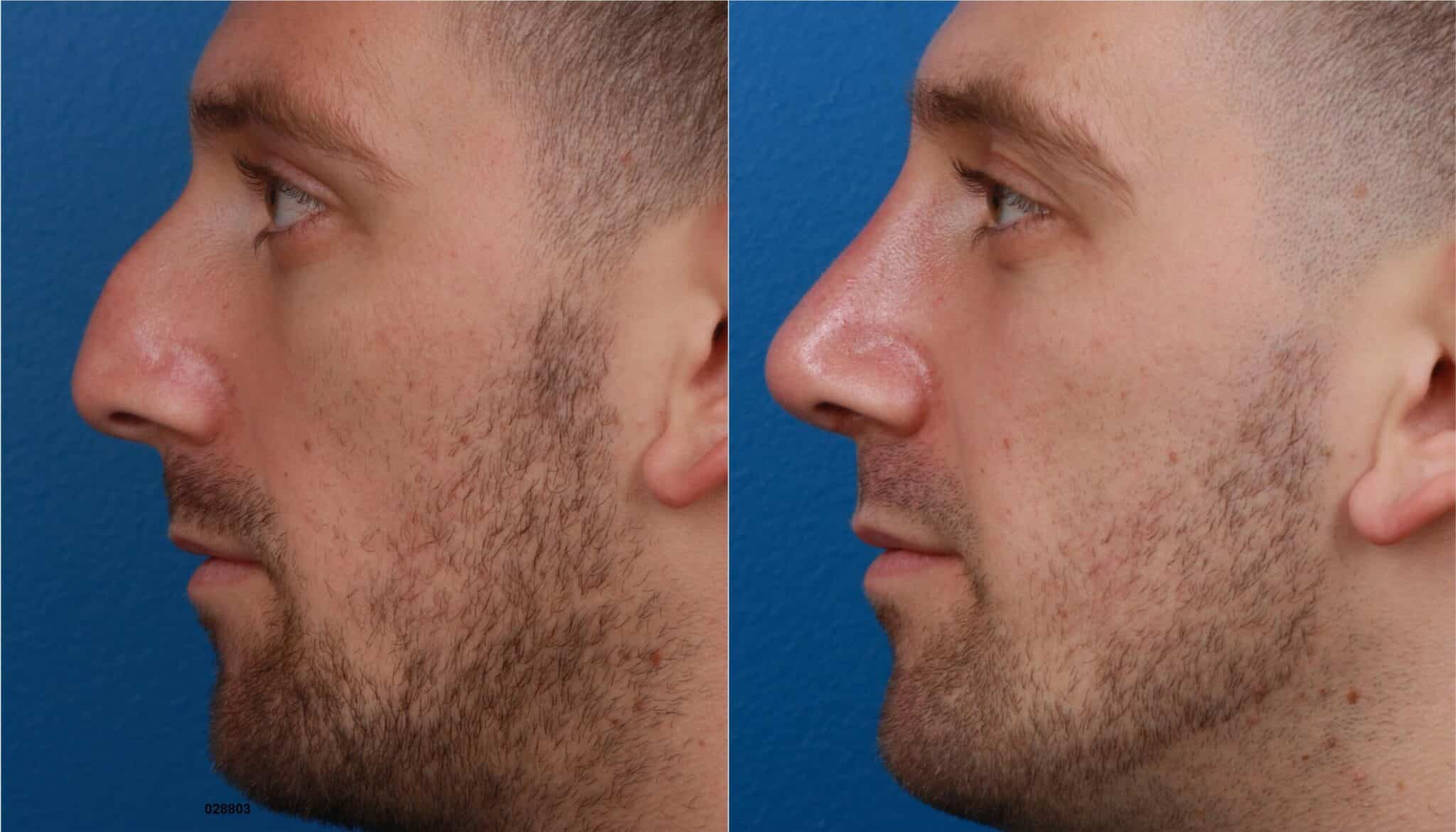 NatraNose rhinoplasty to enhance the appearance of the nose on a male patient by. Surgery removes hump from nasal bridge and adds slight rotation to the nasal tip to improve the facial profile.
