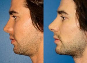 Before and after image of a man who has undergone jawline enhancement surgery in New York City