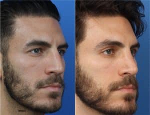 Before and After image of a man undergoing facial wrinkle removal procedures in New York City.