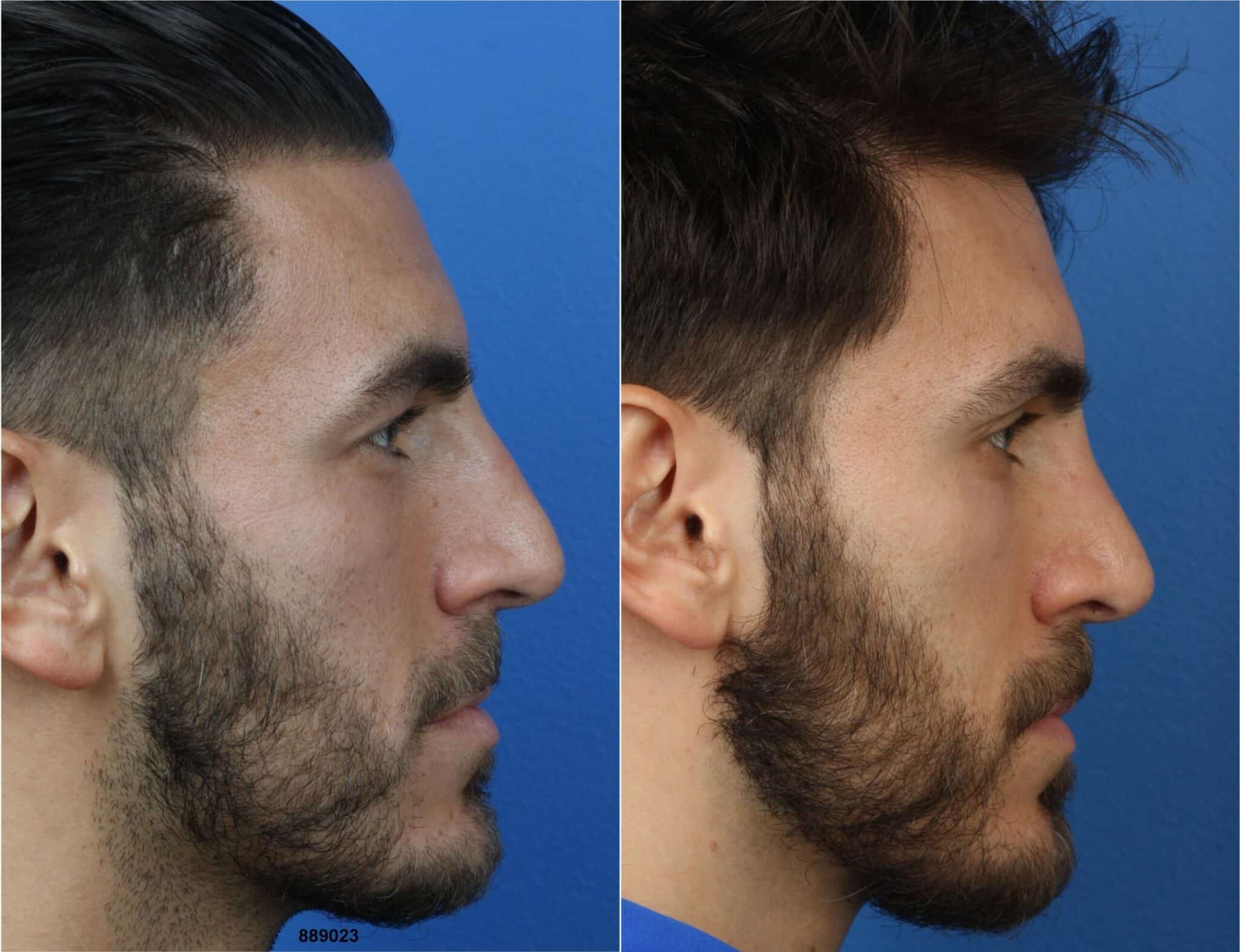 NatraNose technique, trademark of Dr. Philip Miller, to enhance the nose in a male patient. After surgery, nasal bridge has more pleasing slope and tip is slightly refined to create a more aesthetically pleasing profile.