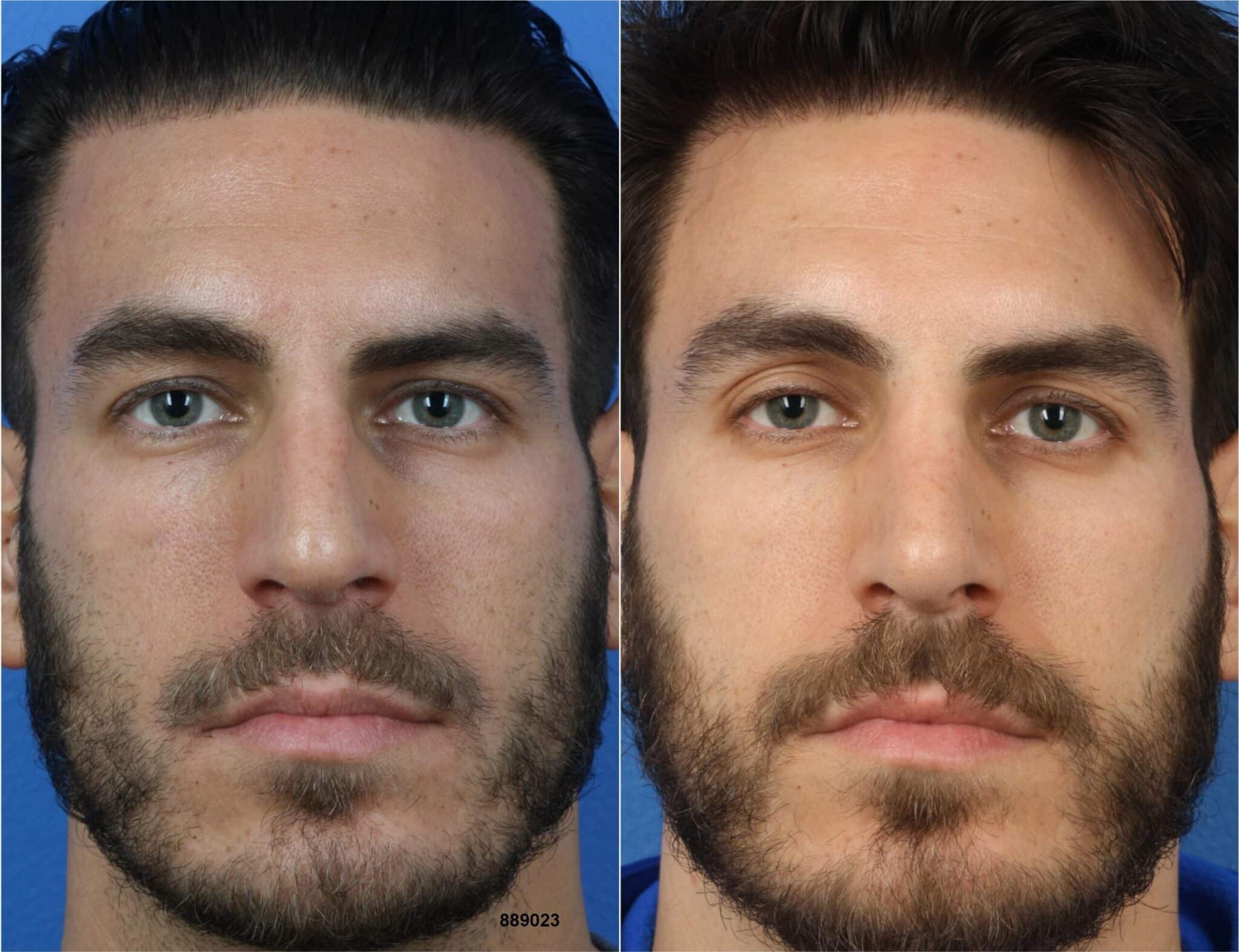 NatraNose technique, trademark of Dr. Philip Miller, to enhance the nose in a male patient. After surgery, dorsal hump removed from nasal bridge and tip is slightly refined for a more aesthetically pleasing shape and appearance.
