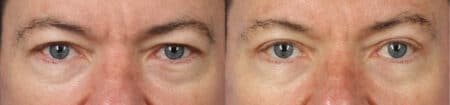 Upper Blepharoplasty with Dr. Miller