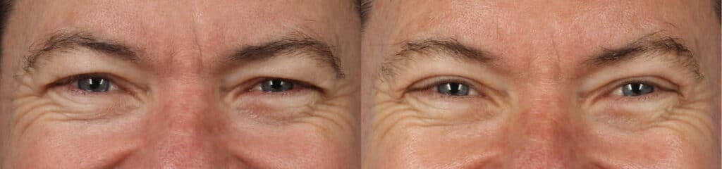 Upper blepharoplasty (eyelid surgery) to lift upper eyelids and refresh the appearance in a male patient. After surgery, eye contour is smoother with fewer wrinkles when patient squints.