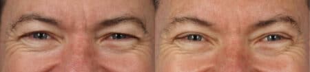 Upper Blepharoplasty with Dr. Miller