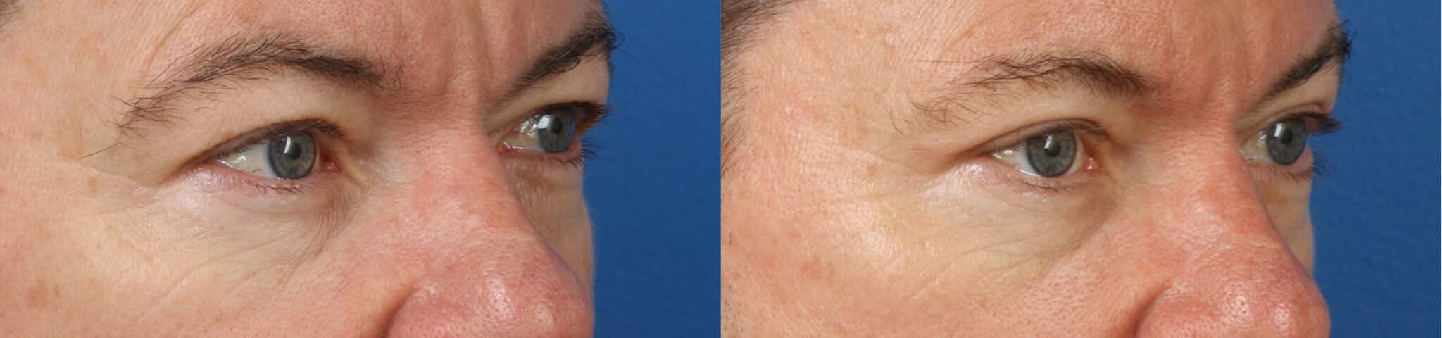 Upper blepharoplasty (eyelid surgery) to raise upper eyelids and rejuvenate the appearance in a male patient. After surgery, eyes are more open and look refreshed.