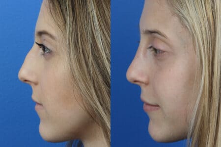 Rhinoplasty and Dermal Fillers with Dr. Miller