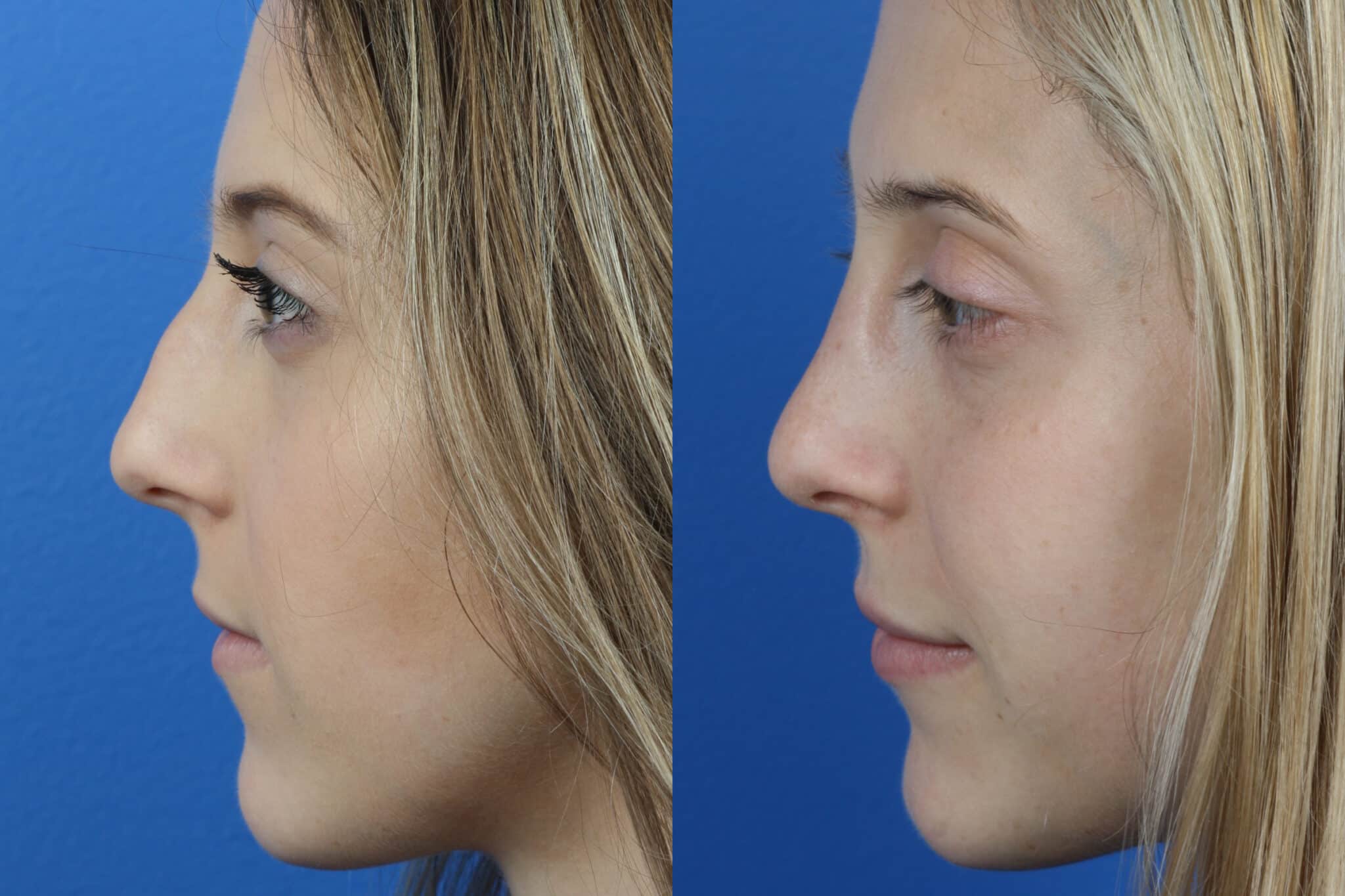 Rhinoplasty to enhance the nose and dermal filler injections to augment the...