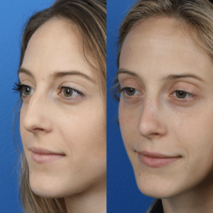 Images showing a young white female before and after a rhinoplasty, New York, NY