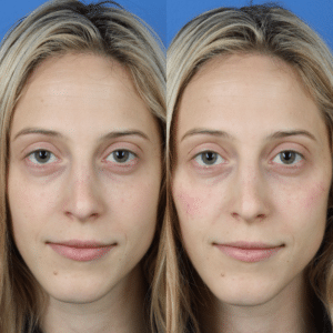 dermal fillers before and after