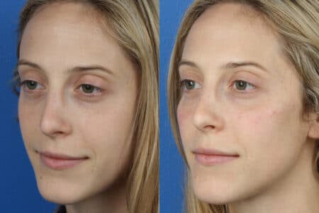 Rhinoplasty and Dermal Fillers with Dr. Miller