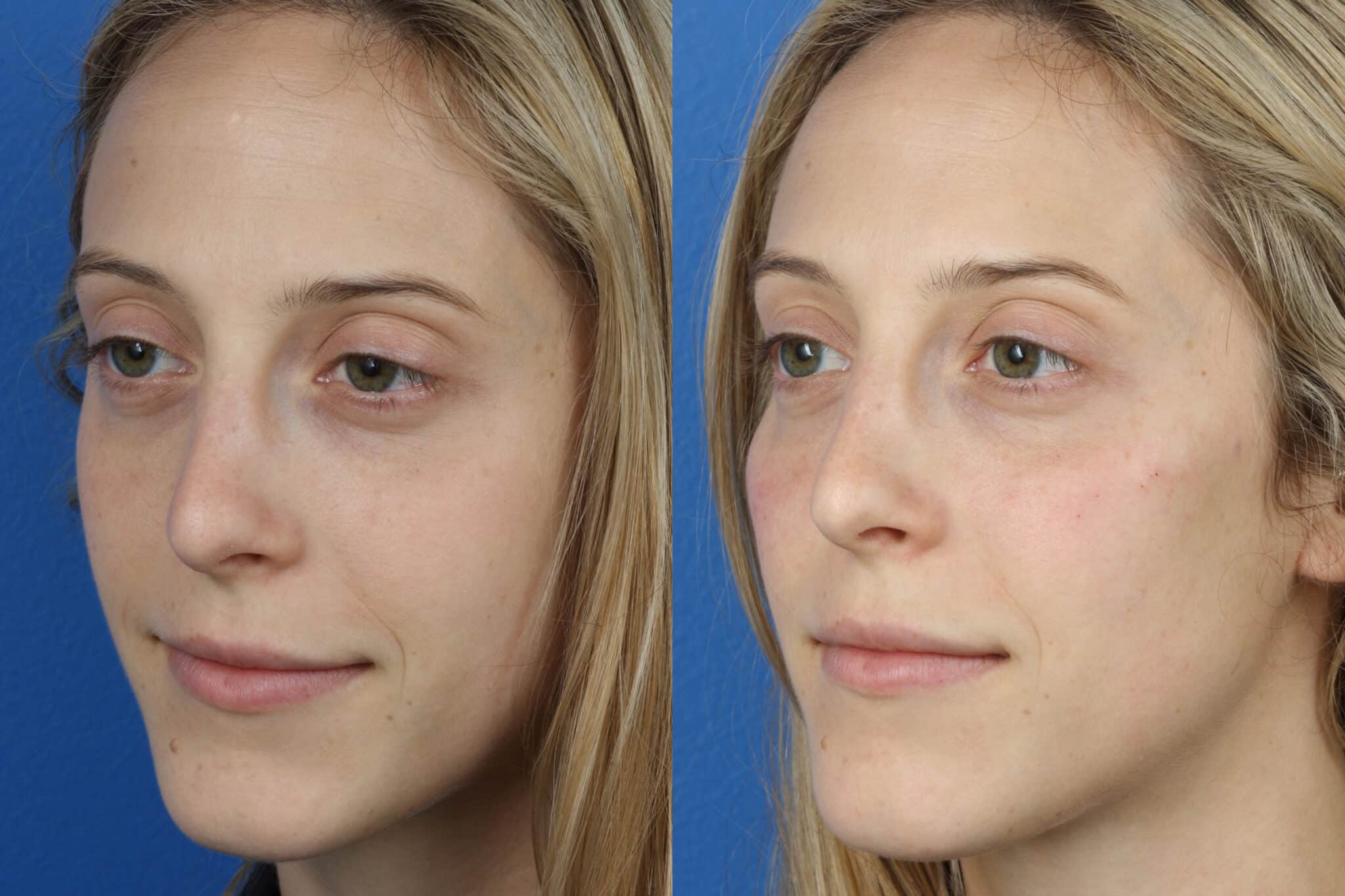 dermal fillers on a female patient before and after