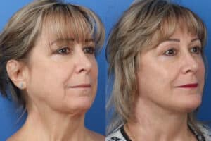 Surgical neck rejuvenation to remove lines and refresh skin. Female patient before and two months after surgery. Asymmetries are corrected to create a smoother neck contour.