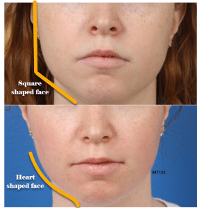 before and after of buccal fat removal