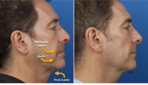 before and after photo of a man who underwent the gi jaw procedure in new york