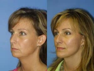 Facelift before and after patient result new york