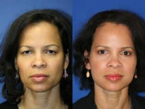 New York Blepharoplasty Eyelid Surgery Before After