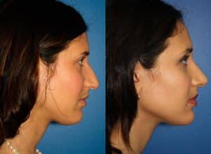 Ethnic Rhinoplasty procedure before and after in new york city