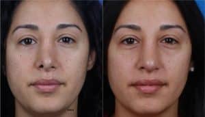 On the left, a woman is shown with an asymmetrical nose and nostrils. On the right, the same woman is shown after NatraNose with a more symmetrical nose