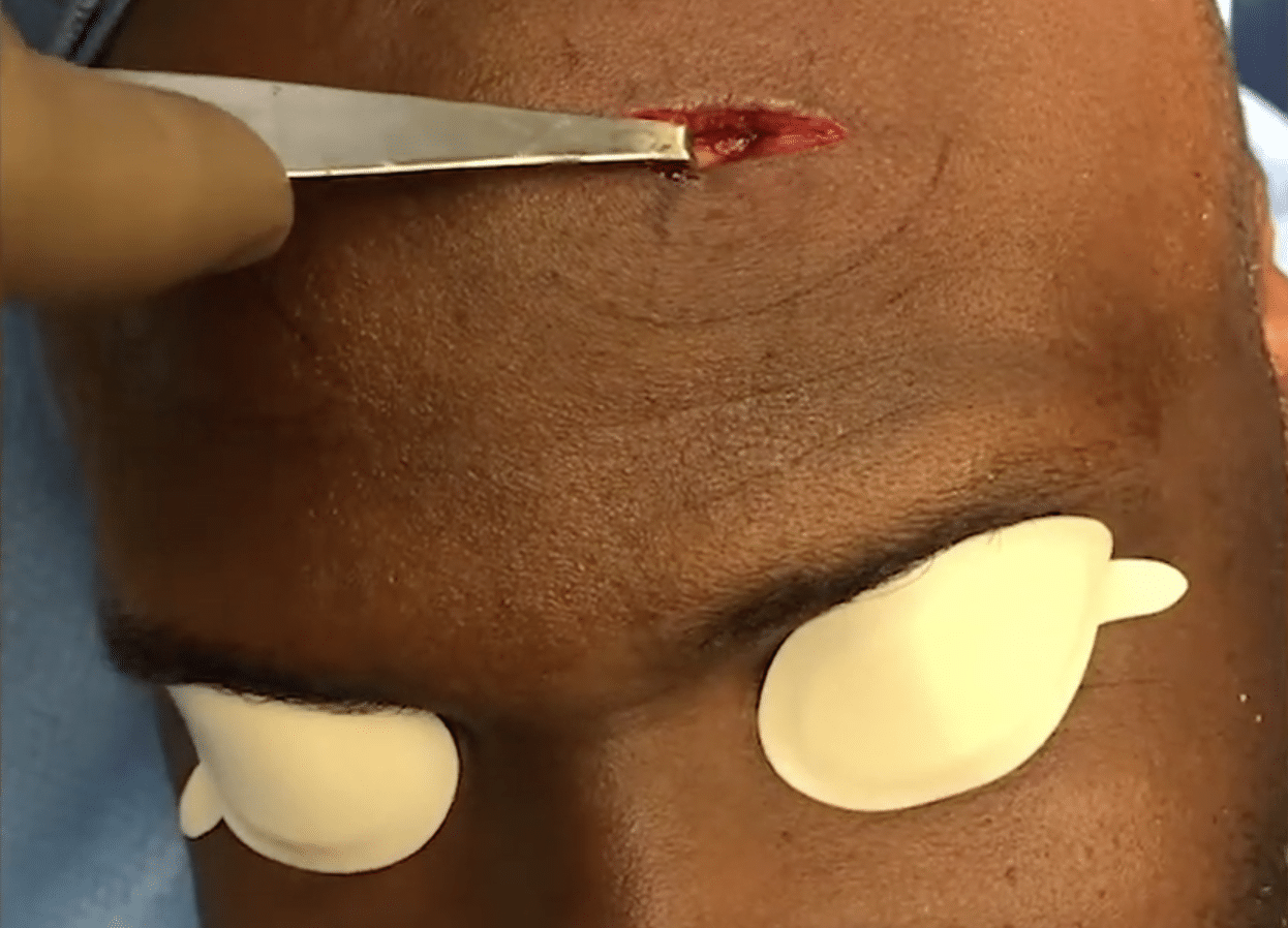 Dr. Philip Miller: Osteoma Removal Demonstration