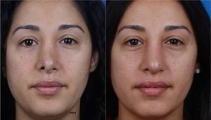 Before after results of rhinoplasty in new york