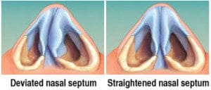 Septoplasty Diagram in New York