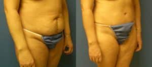 before and after image of a tummy tuck and mommy makeover procedure performed at our plastic surgery clinic in New York City.