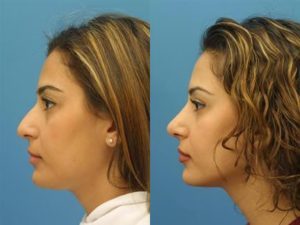 New York Wide Rhinoplasty Surgery Results