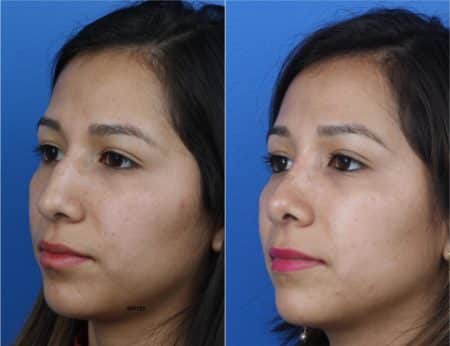 Rhinoplasty to Improve Nasal Bridge and Tip by Dr. Miller