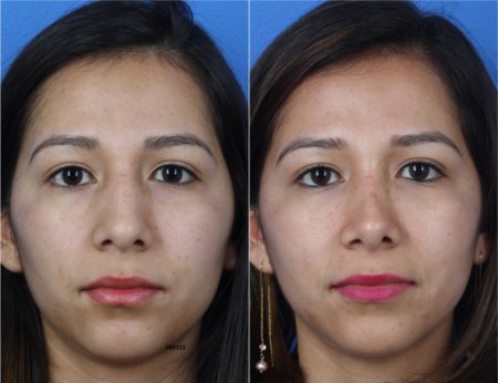 Rhinoplasty to Improve Nasal Bridge and Tip by Dr. Miller