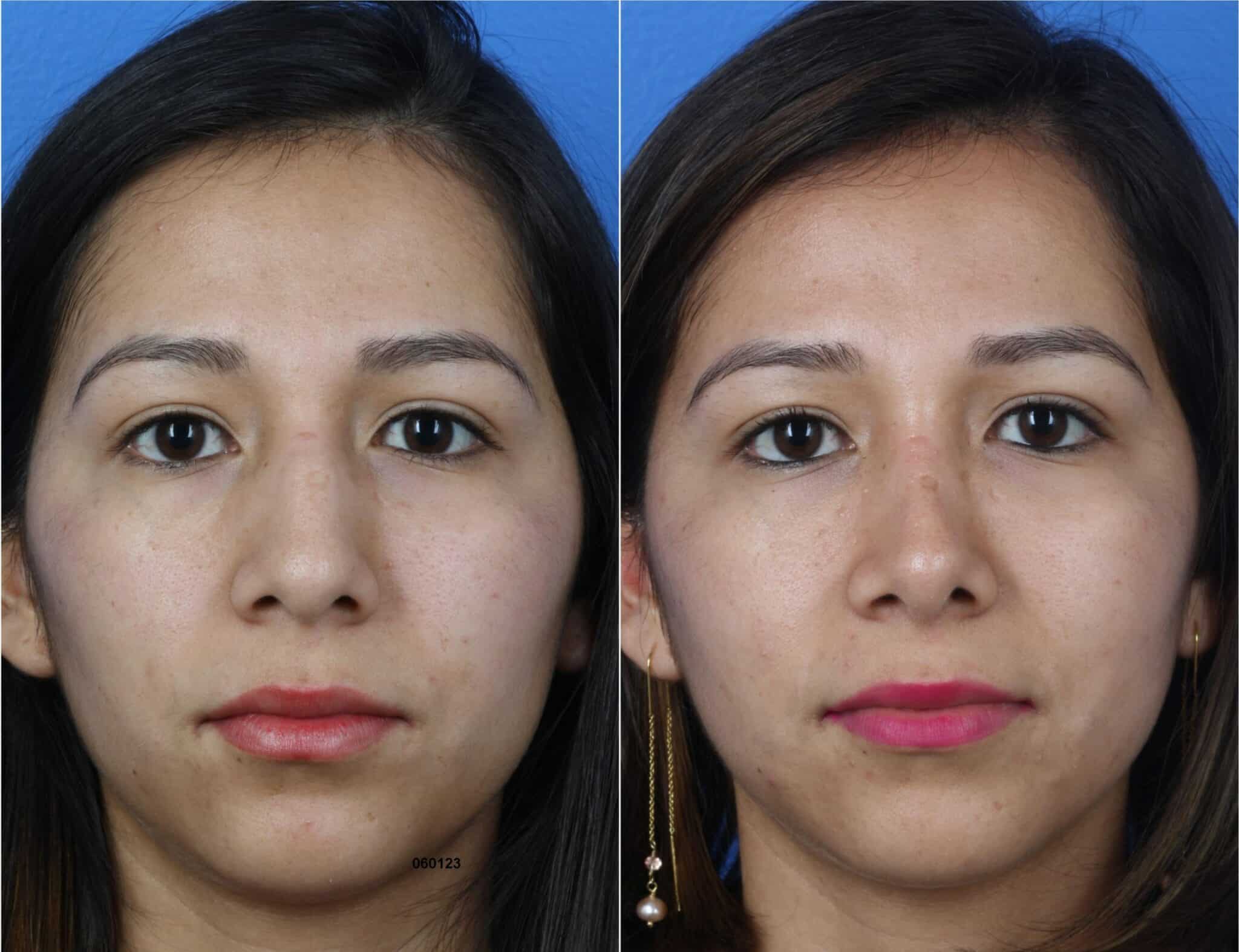Rhinoplasty to improve nasal bridge and tip of a female patient by Dr. Miller. After surgery, tip is refined and nose is proportionate to other facial features.