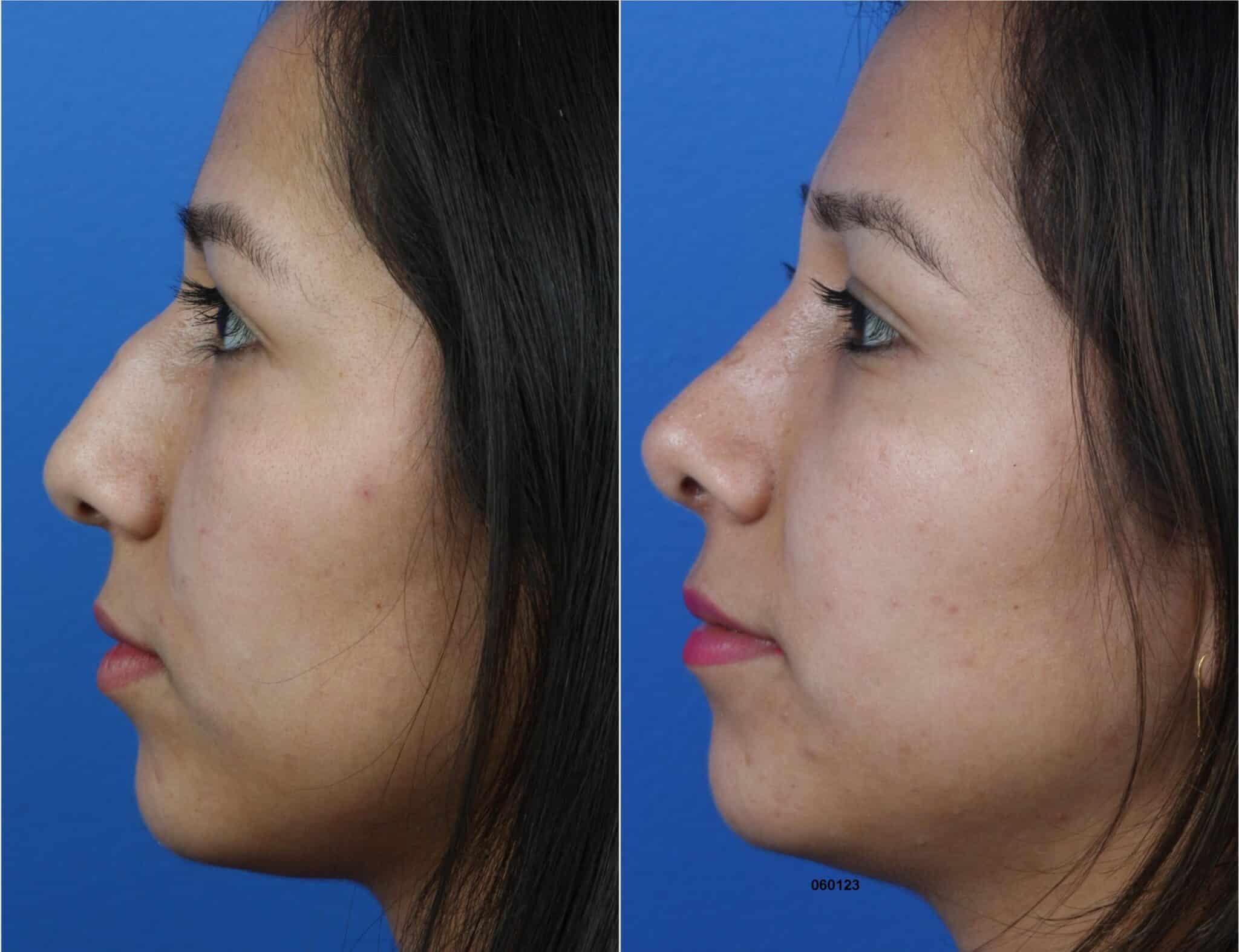 Rhinoplasty to remove hump and rotate nasal tip on a female patient. After surgery, nasal bridge is straighter and patient has an improved profile.