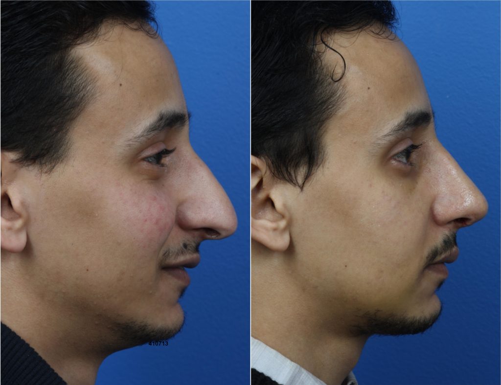 middle eastern rhinoplasty on a male patient in new york