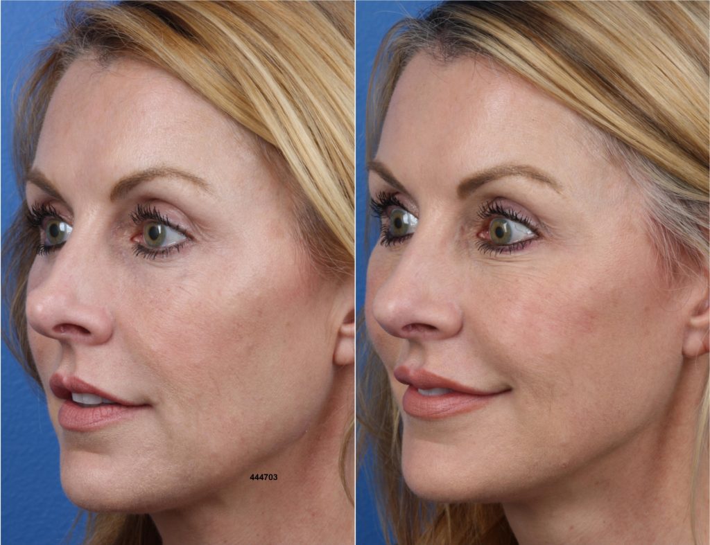 Rhinoplasty using NatraNose technique to improve the shape and profile of the nose of a female patient. After surgery, bridge and tip are improved and more proportionate to other facial features.